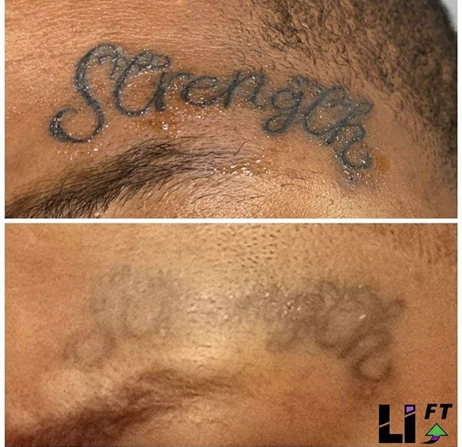 Tattoo Removal Collingswood NJ Laser Tattoo Removal